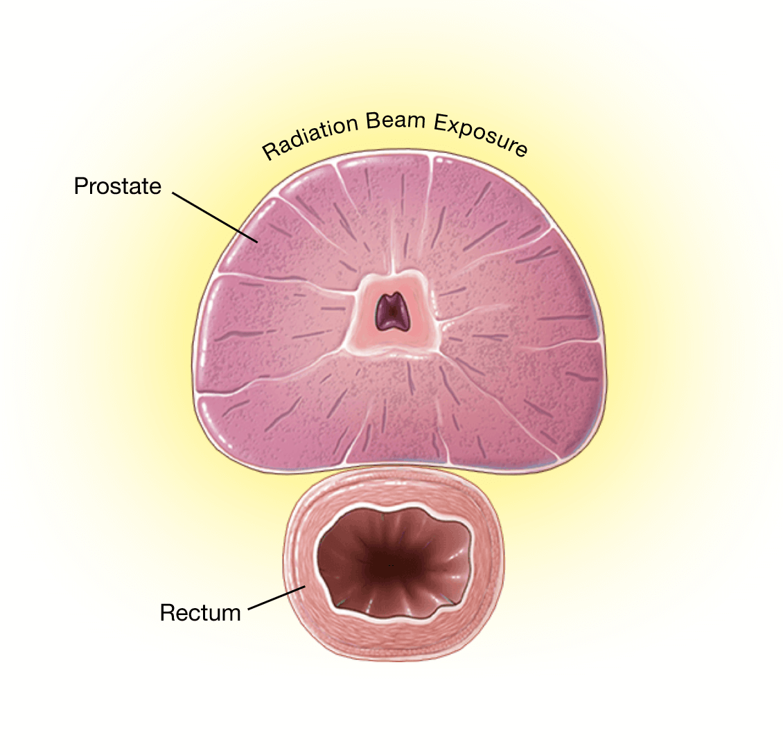 Improving Prostate Cancer Treatment with Hydrogel Spacers