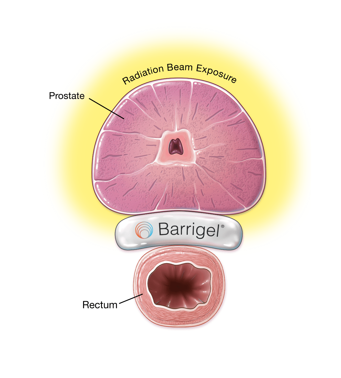 Barrigel Spacer  Minimize Prostate Radiation Side Effects