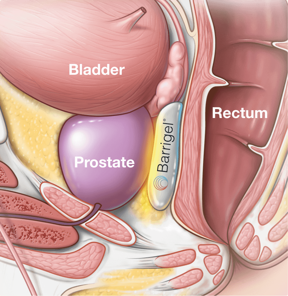 Barrigel Spacer  Atlantic Urology Clinics