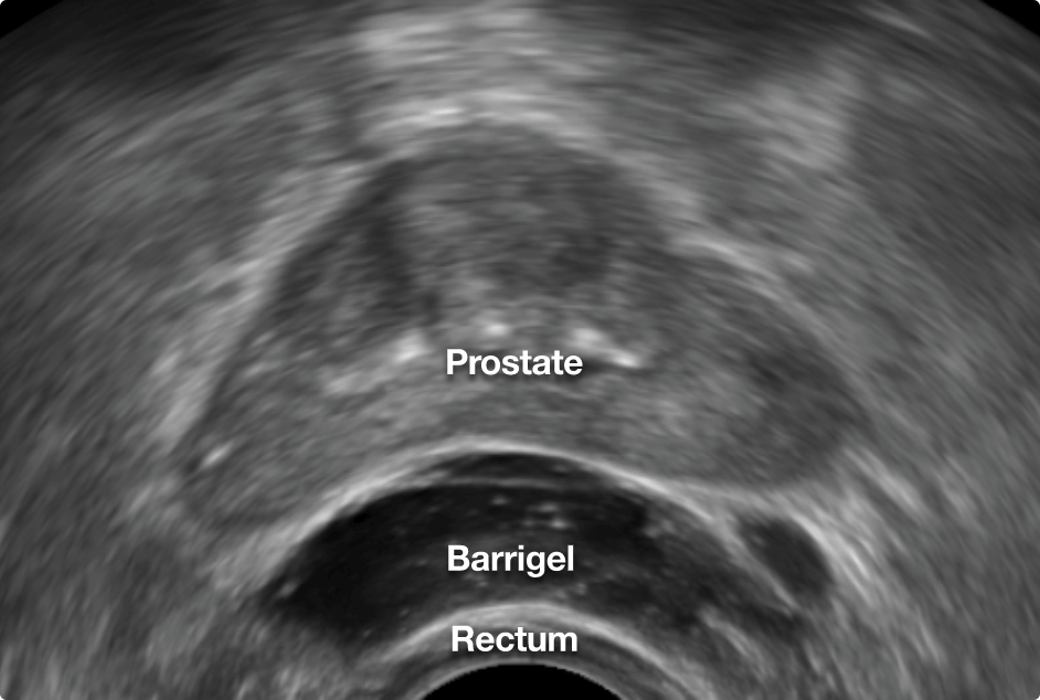 Barrigel Spacer  Atlantic Urology Clinics