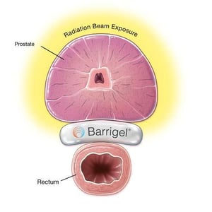 Prostate radiation beam exposure - with Barrigel rectal spacer