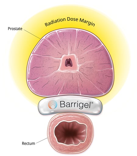 Prostate radiation dose margin illustration with Barrigel spacer to protect rectum Prostate radiation dose margin illustration with Barrigel spacer to protect rectum