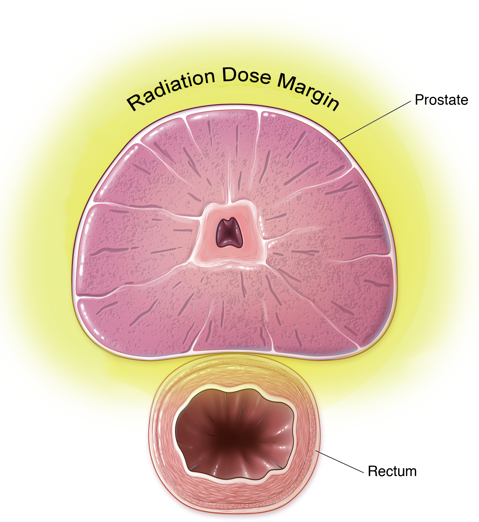 Radiation-Dose-Margin-Without-Barrigel