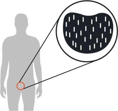 brachy-therapy-simple-illustration