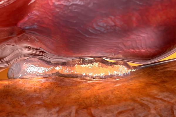 Barrigel protecting rectum during prostate radiation